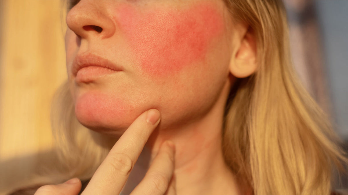 Best Skincare for Facial Redness: The Dr.SANTE Azulene Soother Line for Flushed, Sensitive Skin
